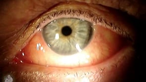 Corneal Dellen after cataract surgery (Video)