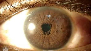 Ectropion uvea of the iris (Video)