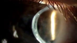 Corneal lens implant (Video)