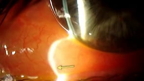 Conjunctival chemosis from eye allergy (Video)