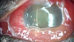 Trabeculectomy Blebitis Infection (Video)
