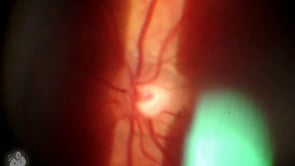 90-diopter view of the retina (Video)