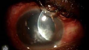 Fungal corneal ulcer (Video)