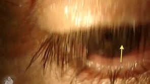 Glaucoma Drop Side Effects (Video)