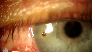 Removing a metal foreign body from the cornea (Video)