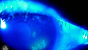 HSV herpetic dendritic ulcer on cornea (Video)