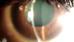 KP (keratic precipitates) on the back of the cornea (Video)