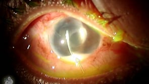 Hypopion layering in the eye (Video)
