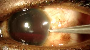 Hyphema eye paracentesis (Video)