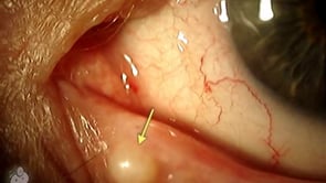 Eyelid epithelial inclusion cyst (Video)