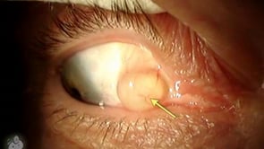 Conjunctival inclusion cyst (Video)