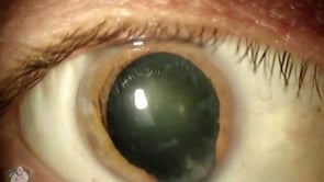 Iris coloboma (Video)