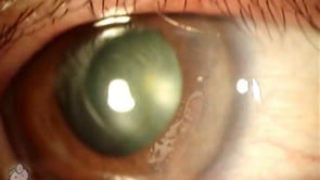 Epithelial Ingrowth after Lasik (Video)