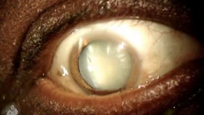 Mature cataract in the eye (Video)