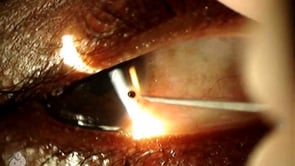 Foreign body removed from cornea with a needle (Video)
