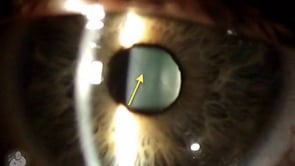 Lens sutures seen in the eye (Video)