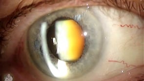 Nuclear Sclerotic Cataract (Video)