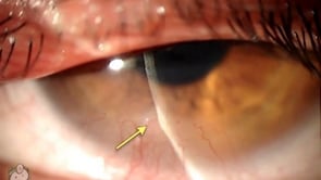 Phlyctenule reaction on the cornea (Video)