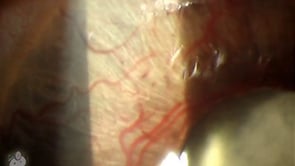 Neovascularization of the Iris (Video)