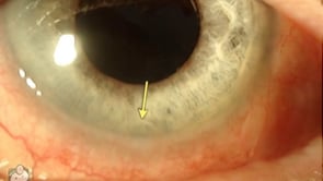 Perfluoron in the anterior chamber (Video)