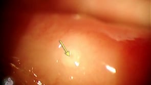 Punctal plugs in the eye (Video)