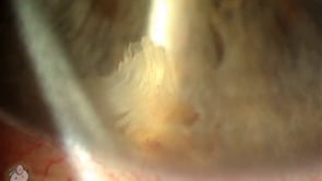 Retained lens material after cataract surgery (Video)