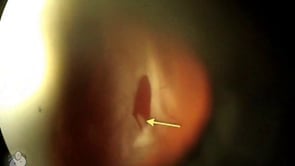Retinal detachment viewed from the slitlamp (Video)