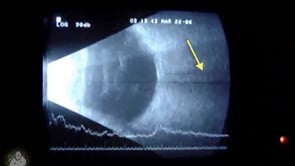 Ultrasound of the eye (Video)