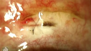 Trabeculectomy Bleb Leak (Video)