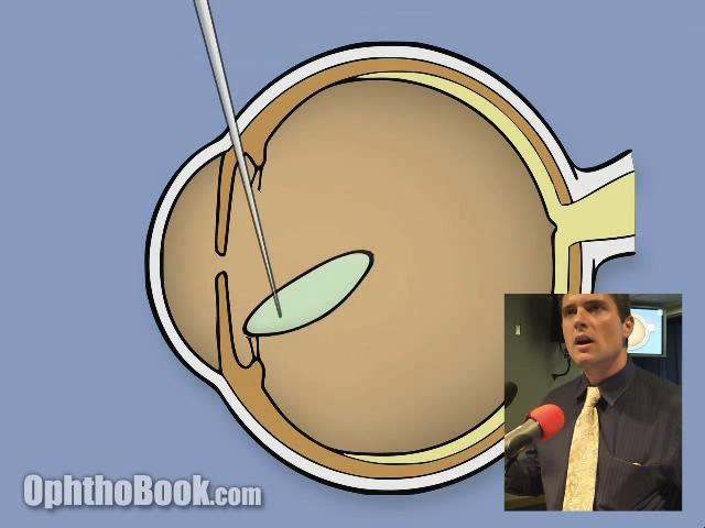 Cataract Presentation (Video) 