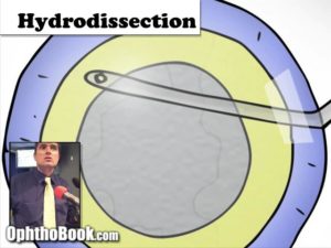 hydrodisection