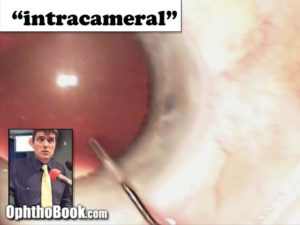 Intracameral