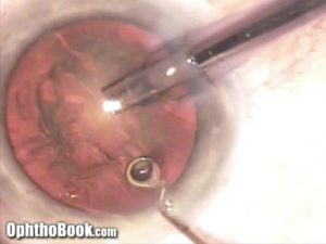 Cartoon Cataract Surgery (Video) 