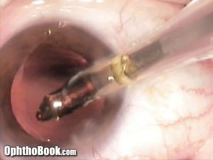 Cataract Implant Insertion