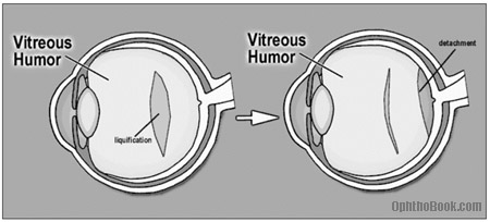 posterior vitreous detachment floaters