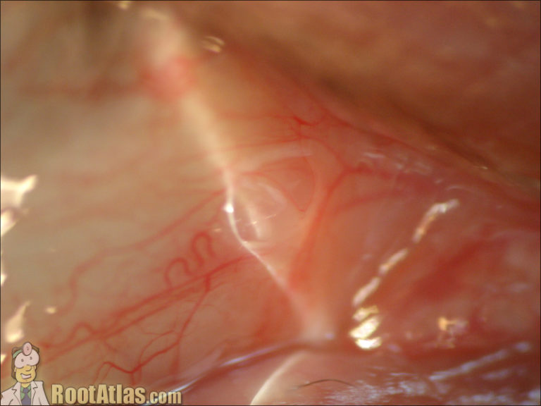 Small Conjunctival Cyst (Photo)