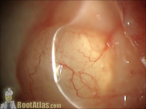 Conj cyst