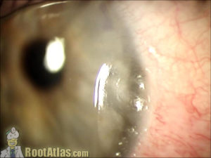 Corneal dellen