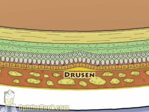 Drusen under retina