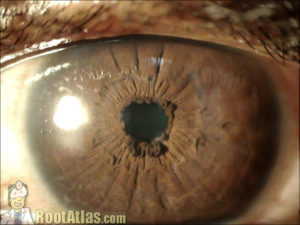 Ectropion Uvea