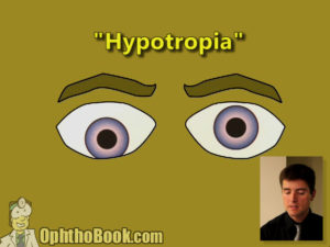 Hypotropia