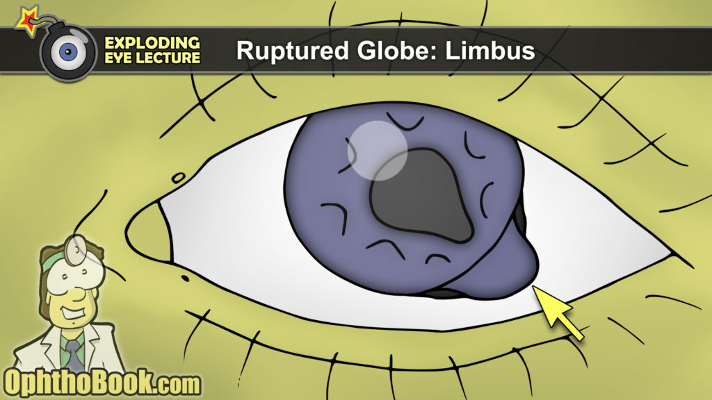 Ruptured Globe - Limbus
