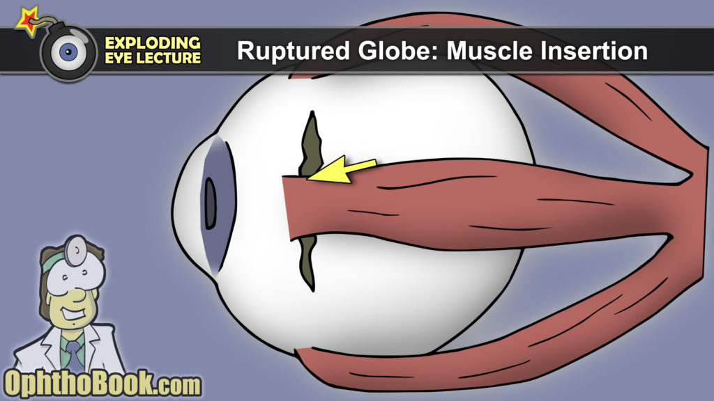 Ruptured Globe - Muscle Insertion
