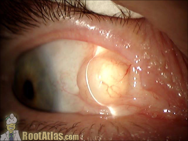 Conjunctival Cyst