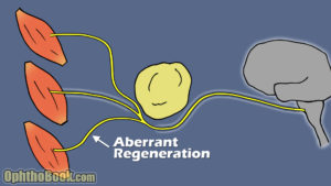 Aberrant Regeneration Tumor