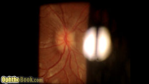 Papilledema
