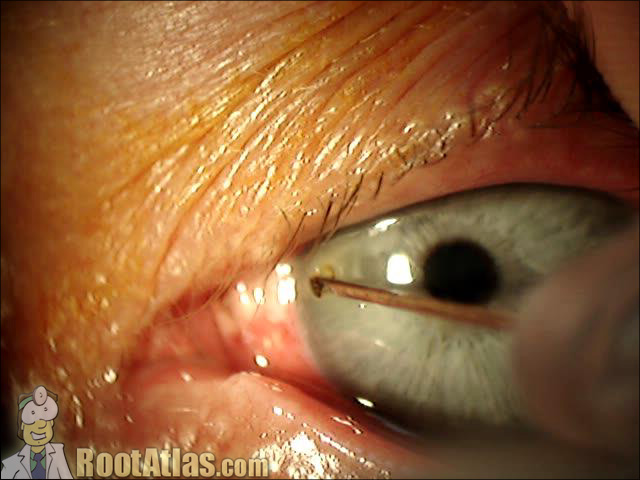 foreign body in eye