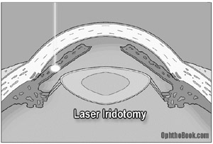 gl-iridotomy.jpg