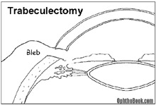 gl-trabeculectomy.jpg