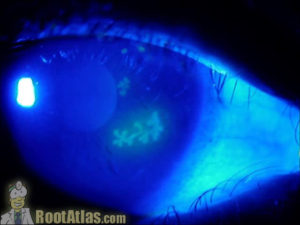 HSV herpetic dendritic ulcer on cornea (Video) - TimRoot.com